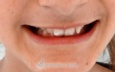 Sourire avant traitement orthodontique